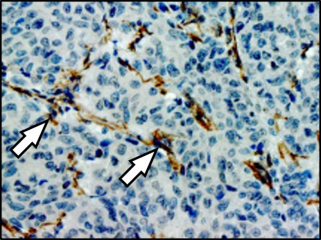 Lung metastasis in a breast cancer patient: the arrows indicate fibroblasts (brown) that communicate with metastatic cancer cells. Cell nuclei are stained blue. © Oskarsson, DKFZ/HI-STEM