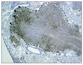 immunostaining of lung metastasis