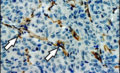 Lung metastasis in a breast cancer patient: the arrows indicate fibroblasts (brown) that communicate with metastatic cancer cells. Cell nuclei are stained blue. © Oskarsson, DKFZ/HI-STEM