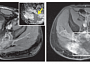 Chordoma Research